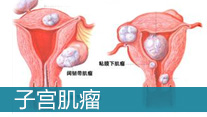 子宫肌瘤的治疗方法_马鞍山妇科医院